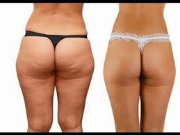 celulitis y estrias